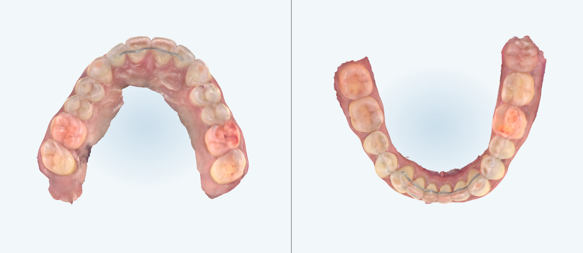 Spacing treatment comparison case 2 after